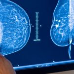 AI falls short in breast imaging classification
